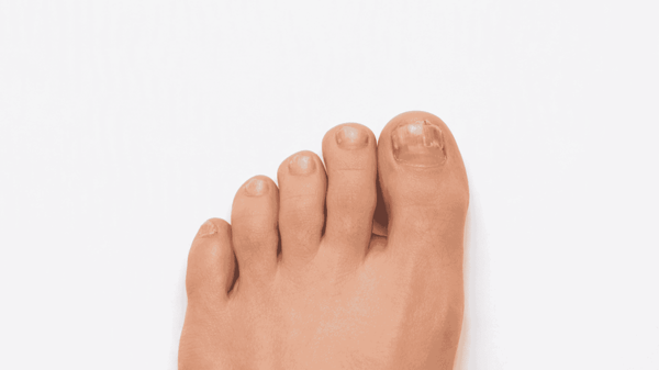 Fungal-nail-infection